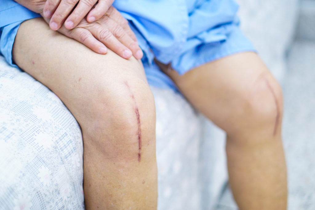 Do I Need a Joint Replacement?